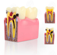 Decay Teeth Model/Caries Teeth Model/Tooth Model