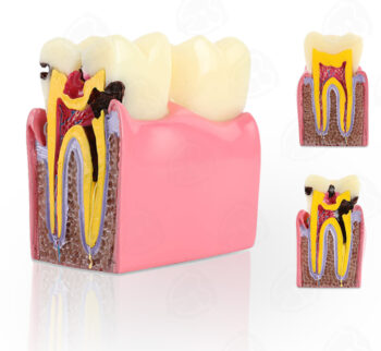 Decay Teeth Model/Caries Teeth Model/Tooth Model